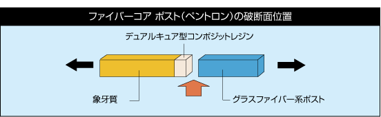 ファイバーコア ポスト（ペントロン）の破断面位置